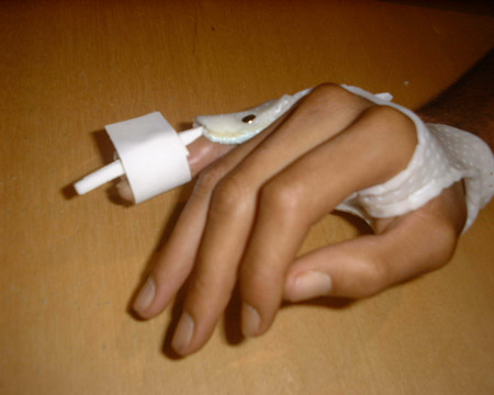 orthese en extension sur le doigt
