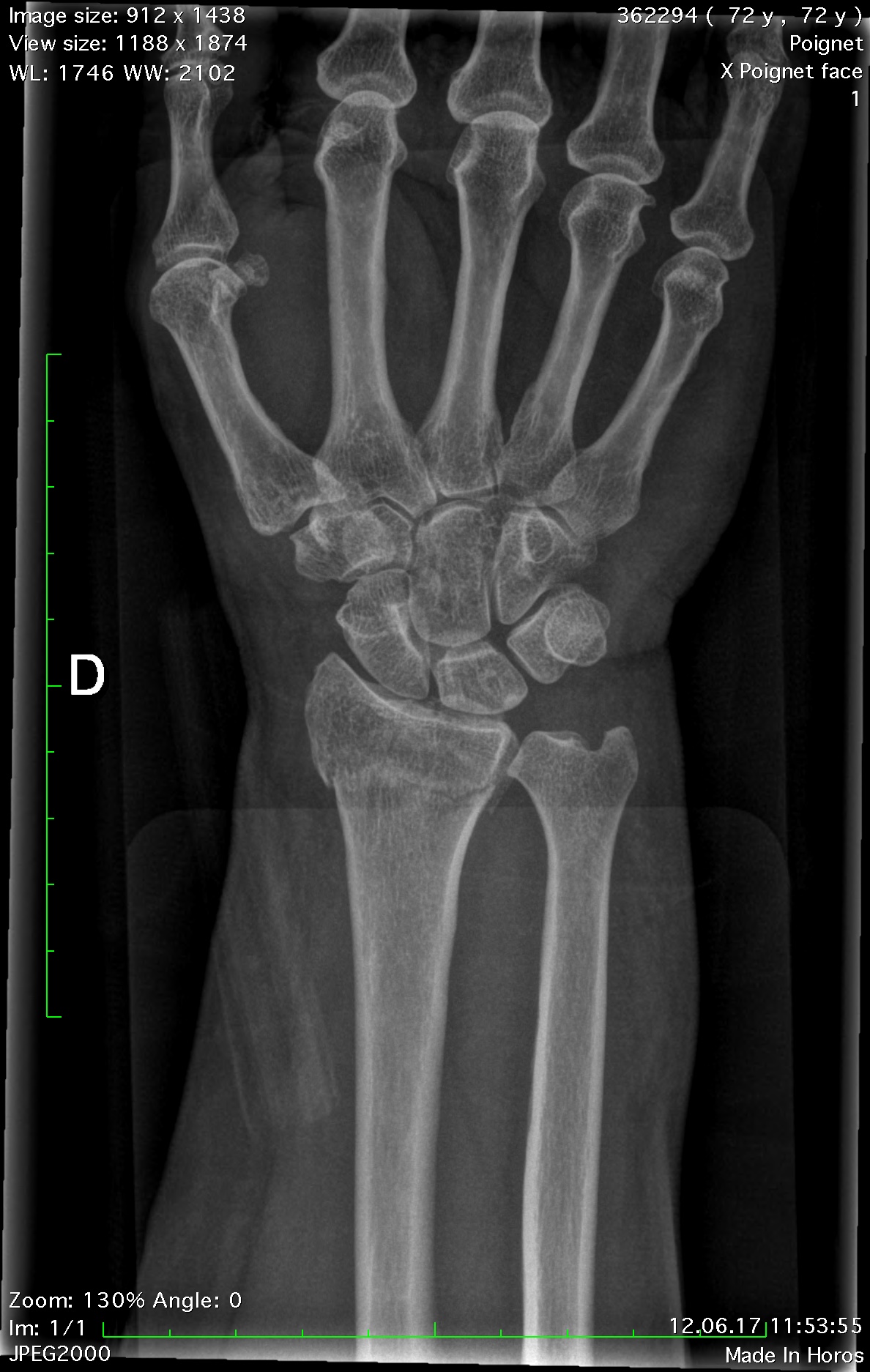 compression fracture in wrist