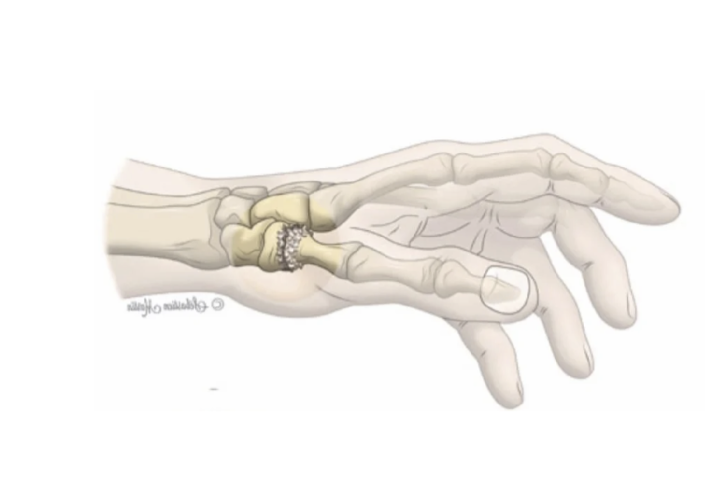 Arthrose et usure articulaire du poignet et de la main